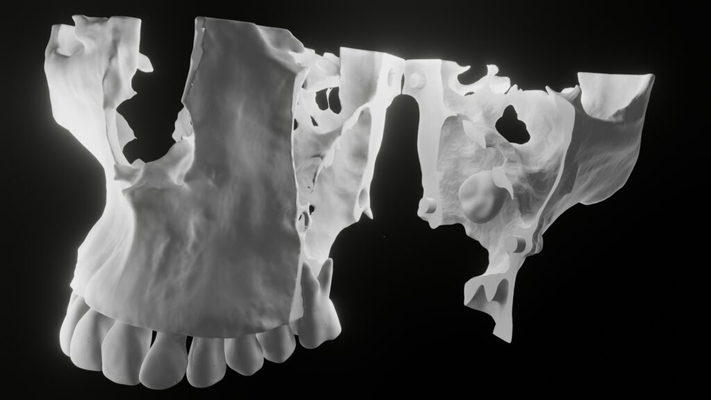 diagnostic 3d model dentigerous cyst