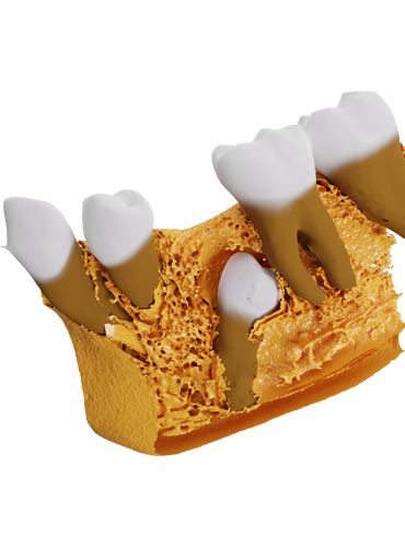 dental 3d printing