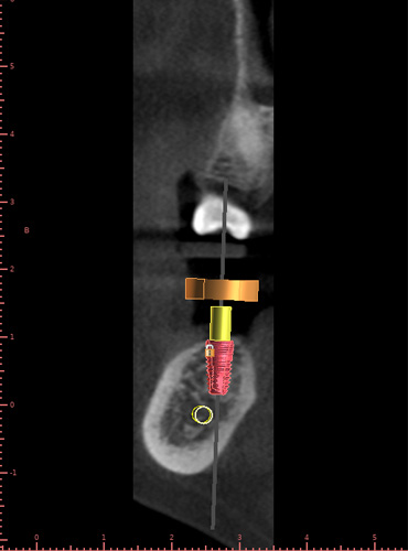 implant planning