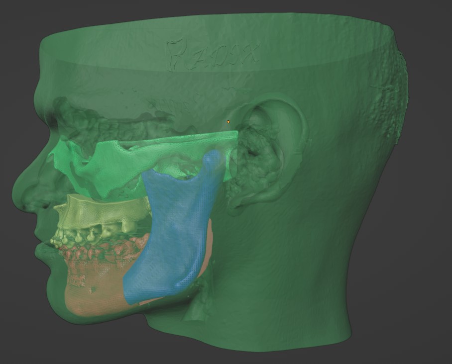 Orthognathic simulations